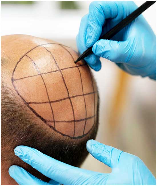 Direct Hair Implantation (DHI)