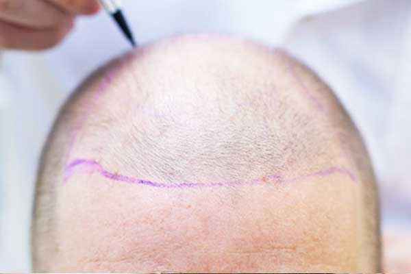 Facial Hair Transplantation