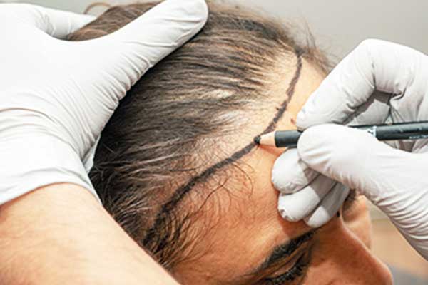 Unlocking the Secret to a Fuller, More Luxurious Mane: Body Hair Transplantation